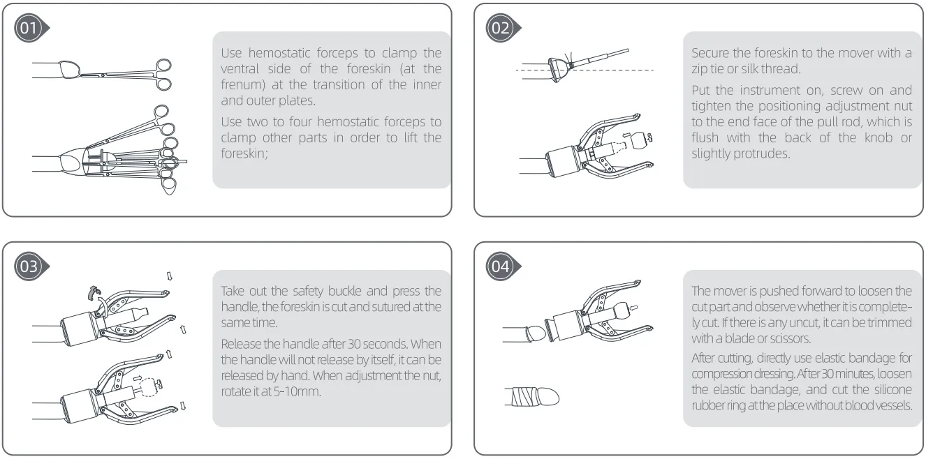 circumcision stapler-03.webp